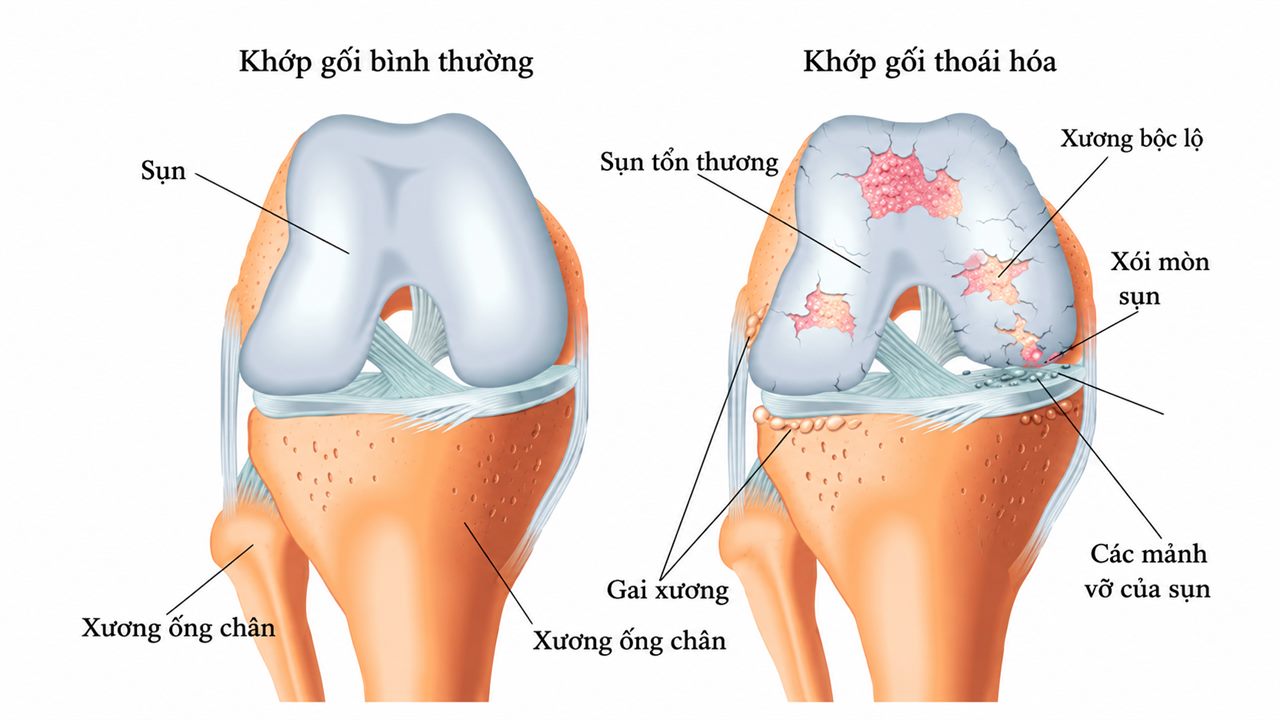 So sánh khớp gối bình thường và khớp gối thoái hóa: sụn tổn thương, gai xương, xói mòn sụn, xương bộc lộ